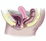 Лечение пролапса тазовых органов