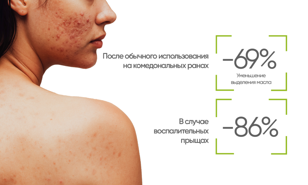 Крем для проблемной кожи с акне Bioderma Sebium Global V2, 40 мл - фото 4 - id-p115431251