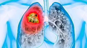 Рак легких причины и последствия для человека