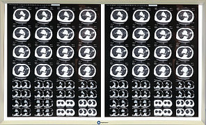 Двухкадровый негатоскоп Negatoscope