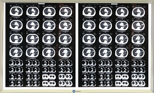 Негатоскопы