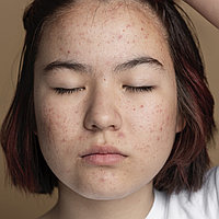 Безеуді кешенді емдеу