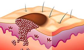 Симптомы, диагностика и лечение рака кожи