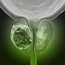 Рак простаты: симптомы и лечение