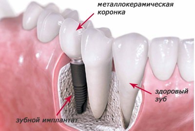 Имплантация (Израиль - Alfa Bio)