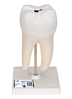 Модель нижнего двухкоренного моляра, демонстрирующая кариозное разрушение, 2 части