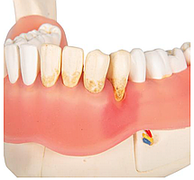 Модель болезней зубов