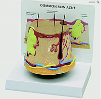 Модель кожной угревой сыпи (с увеличением)