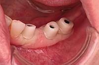 Протезирование зубов. Виниры