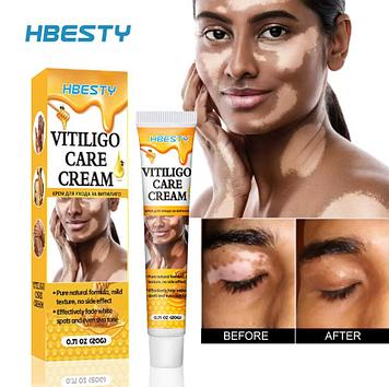 HBESTY Vitiligo Care Cream - Крем для ухода за витилиго 20 гр