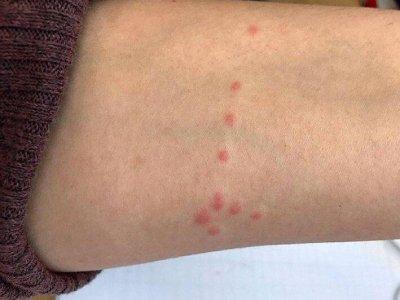 укусы клопов