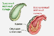 Профилактика заболеваний желчного пузыря