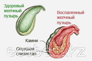 Профилактика заболеваний желчного пузыря