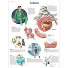 Плакат анатомический  "Астма" 