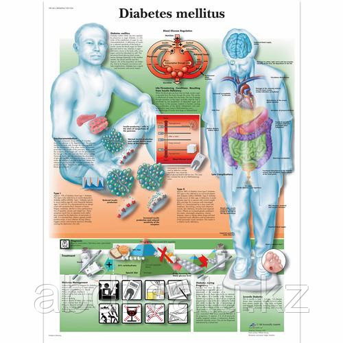 Плакат анатомический  "Диабет" 