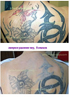 Лазерное и безлазерное  удаление татуажа