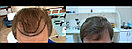 Безоперационная пересадка волос метод FUE в Алмате, фото 3