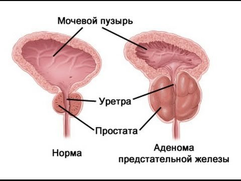 Аденома предстательной железы. Комплекс 4
