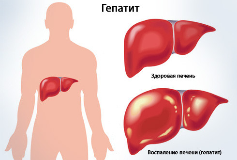 Гепатит. Комплекс 1