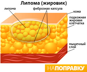 Жировики-липомы. Комплекс