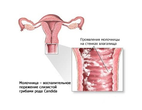 Кандидоз. Комплекс