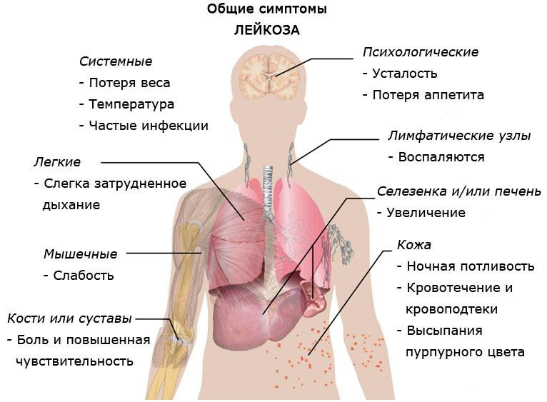 Лейкоз, лимфолейкоз. Комплекс 2
