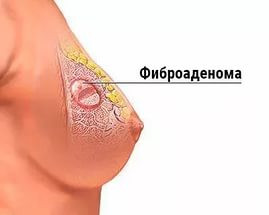 Мастопатия, фиброаденома молочной железы. Комплекс 1
