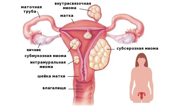Миома, фибромиома матки. Комплекс 1