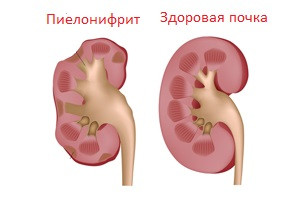 Пиелонефрит. Комплекс 1