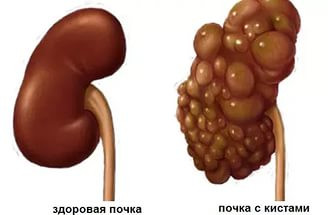 Поликистоз почек. Комплекс 2