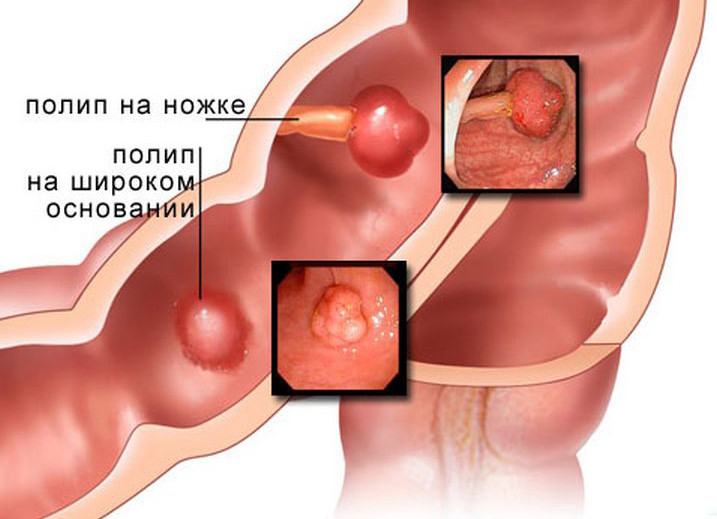 Полипы в желудке, кишечнике. Комплекс 1