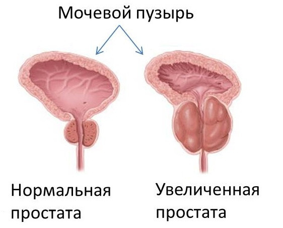 Простатит. Комплекс 1
