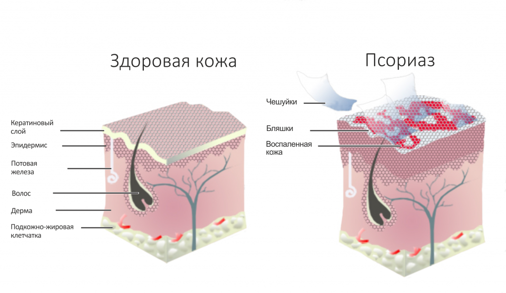 Псориаз. Комплекс