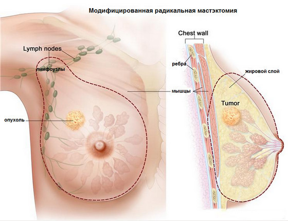 Рак груди. Комплекс