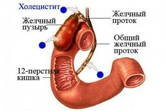Холецистит. Комплекс