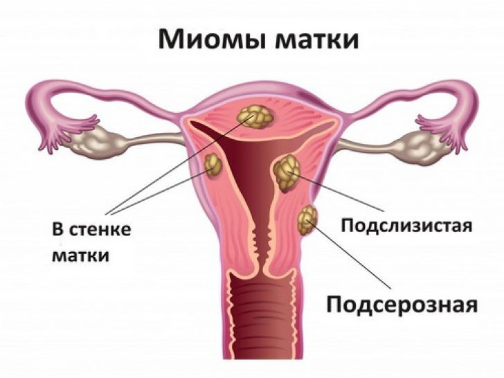 Эндометриоз, миома. Комплекс