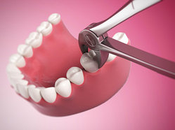 Стоматологические услуги в алматы. Удаление зуба