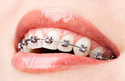 Брекеты - ортодонтическая стоматология