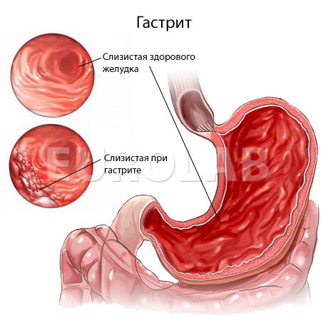 Фиточай Гастрит, колит, панкреатит, язва (при повышенной кислотности), 180 гр