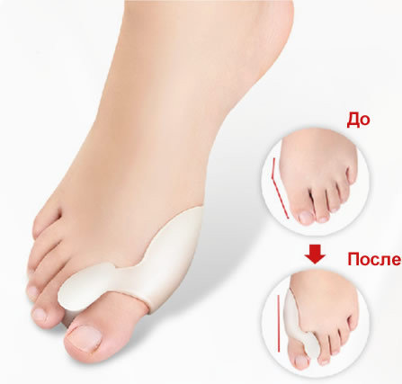 Фиксатор от косточки на ноге дневной (Valgus Pro), ОРИГИНАЛ, фото 2