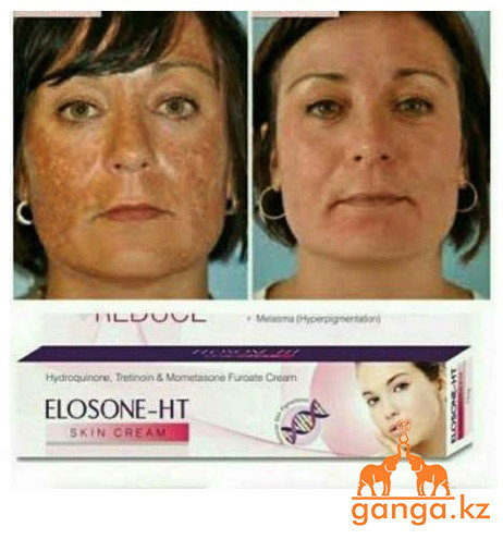 Krem Ot Pigmentnyh Pyaten Pryshej I Morshin Elosone Ht Gidrohinon Tretinoin I Mometazon 25 Gr Prodazha Cena V Karagande Krem Dlya Lica Ot Ganga Internet Magazin Krem Ot Pigmentnyh Pyaten Pryshej I Morshin Elosone Ht Gidrohinon Tretinoin I Mometazon 25 Gr Prodazha Cena V Karagande Krem Dlya Lica Ot Ganga Internet Magazin