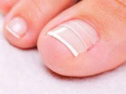 BS-пластина – коррекция вросшего ногтя 