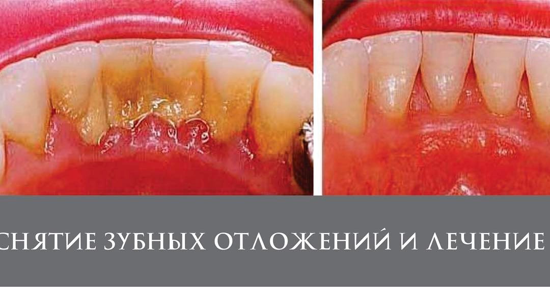 Удаление зубного камня - фото 2 - id-p57279814