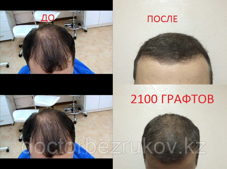 Пересадка бороды в Алматы - фото 2 - id-p1445287