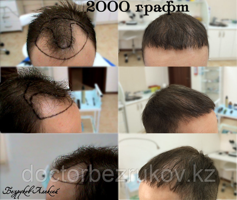 Трансплантация волос Алматы