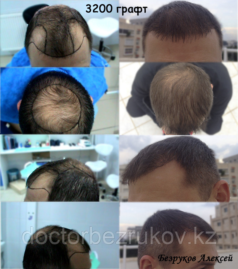 1 графт сколько волос. 1 графт сколько волос. 1 графт сколько волос. 1 графт сколько волос. Графты для пересадки волос.